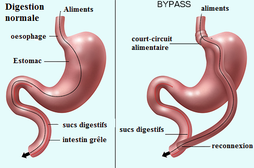 bypass gastrique tunisie
