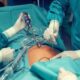 chirurgie obésité endoscopique