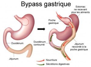bypass gastrique turquie